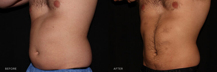 Before and after of a man's stomach from the oblique angle before and after cool sculpting. Before cool sculpting he had a lot of excess fat on the abdomen and love handles. After cool sculpting he has a much more defined midsection. | Albany, Latham, Saratoga NY, MedSpa