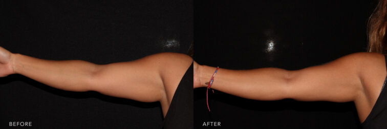 Before and after of a woman's arm held out straight to the side before and after cool sculpting treatment. Before treatment she had some excess fat under her arm. After cool sculpting her arm is thinner and there's less excess fat. | Albany, Latham, Saratoga NY, MedSpa