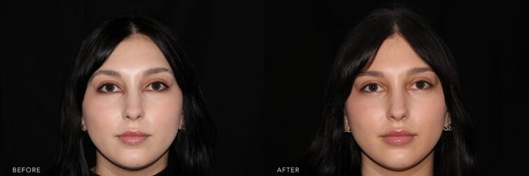 Before and after photo of a young woman with black hair taken from the front angle before lip filler. | Albany, Latham, Saratoga NY, MedSpa