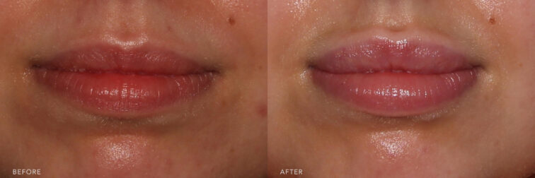 Side by side before and after of a woman's lips from the front angle before and after lip filler. Before filler she had full lips but wanted more fullness. After filler her lips are very full and plump. | Albany, Latham, Saratoga NY, MedSpa