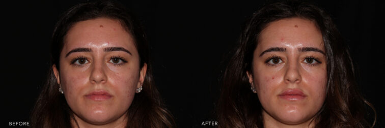 Side by side before and after of a brunette young woman's face taken from the front angle before and after lip filler. Her lips before filler were small and thin. After filler her lips are larger and more full with added hydration. | Albany, Latham, Saratoga NY, MedSpa