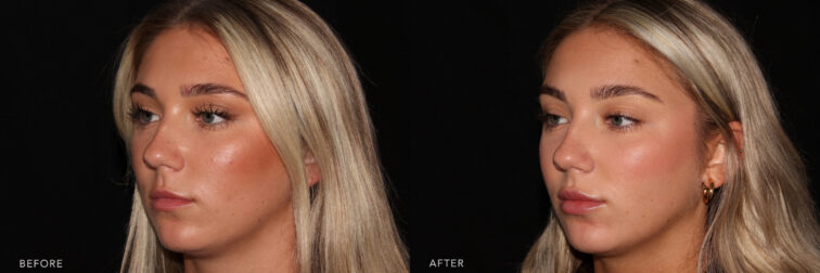 Side by side before and after of a young blonde woman's face taken from the oblique angle before and after lip filler. Before lip filler she had a good shape and size to them from previous lip filler. After lip filler her lips are slightly bigger with added hydration. | Albany, Latham, Saratoga NY, MedSpa