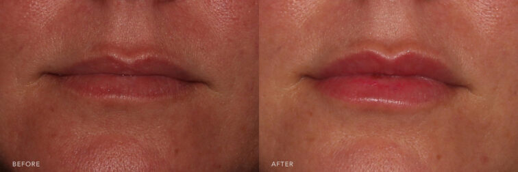 Side by side before and after of a woman's lips taken from the front angle very close up before and after lip filler treatment. Before lip filler her lips are very small and thin. After lip filler her lips have additional volume, height, and hydration following filler. | Albany, Latham, Saratoga NY, MedSpa