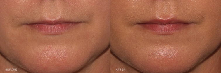 Before and after of a woman's lips taken from the front angle after botox treatment. Before botox her lips were very flat and small. After botox her top lip is subtly larger than before. | Albany, Latham, Saratoga NY, MedSpa