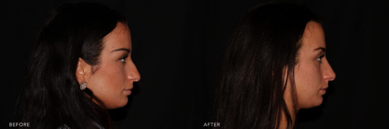 Before and after of a girl's side profile before and after filler in her nose. Before filler she had a nasal bump that was visible causing her nose to appear larger. After filler the nasal bridge is straighter and her nose looks smaller. | Albany, Latham, Saratoga NY