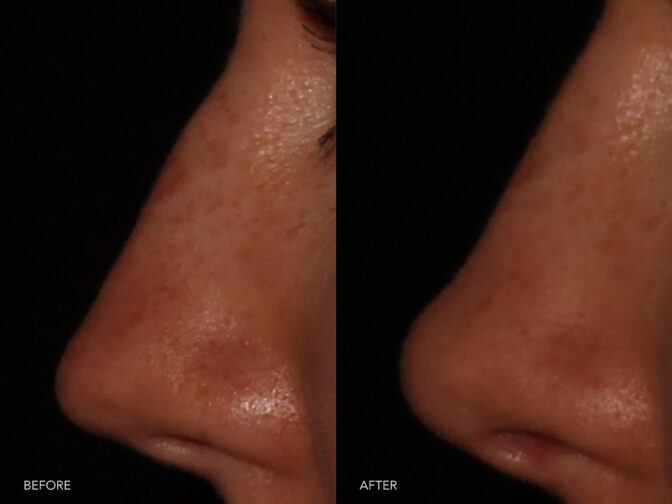 Side by side before and after of a woman's nose taken very close up from the side profile angle. Before filler she had a nasal bump and a very pointed tip. After filler her nasal bridge is straight and her tip has been softened and lifted. | Albany, Latham, Saratoga NY