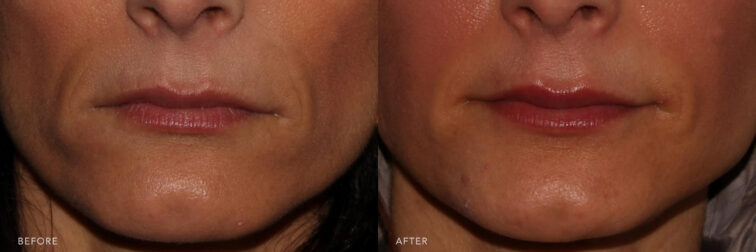 Before and after photo of a woman's lower face taken from the front angle before face filler. She has a loss of volume in her lower face causing her smile lines to protrude from her face. Filler was injected around this region to aid in the sunken in appearance around these lines. Her smile lines are less noticeable after filler. | Albany, Latham, Saratoga NY, MedSpa