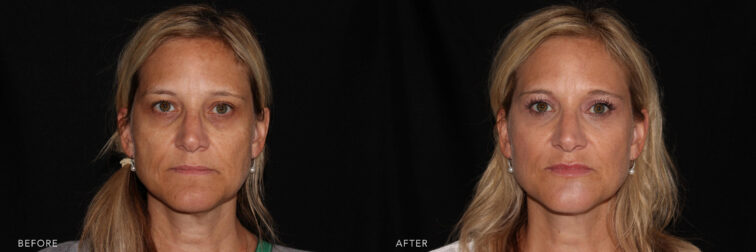 This is a blonde woman's photos before and after Botox and Dysport procedure. Before photo shows loose and wrinkled skin on her cheeks through her jowls with dark circles below her eyes while after photo shows more brighter and compact skin on her cheeks and evenly shaped jawline that makes her look younger.| Albany, Latham, Saratoga NY, MedSpa