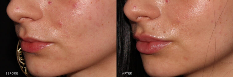 This is a side by side view photo of a woman's lips before and after Lip Filler procedure. Before photo shows slimmy lips and after photos shows more full lips and evenly shaped upper and lower lips. | Albany, Latham, Saratoga NY, MedSpa