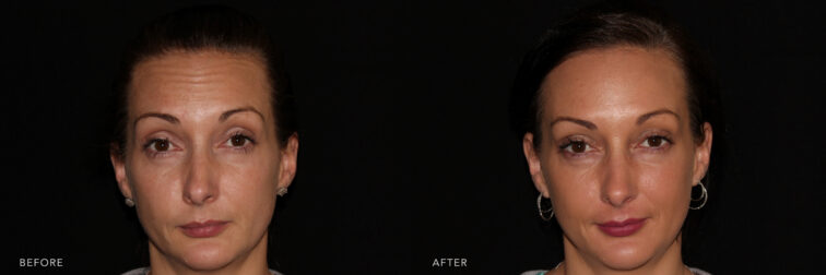 This a prfile photos of a woman's face with a black hair before and after Botox & Dysport procedure. Before photo shows wrinkly forehead and toneless skin on her mid face while after photo shows more brighter, evenly toned and tighter skin.| Albany, Latham, Saratoga NY, MedSpa