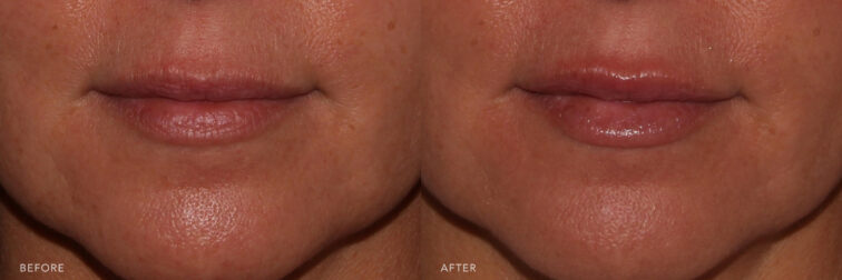This is a photo of a woman's lips before and after Lip Filler procedure. Before photo shows wrinkled lines around her mouth with her thinned lips and evident loss of her lips volume while after photo shows more defined lips and evenly shaped with a tighter skin around her mouth that makes it look smoother.| Albany, Latham, Saratoga NY, MedSpa