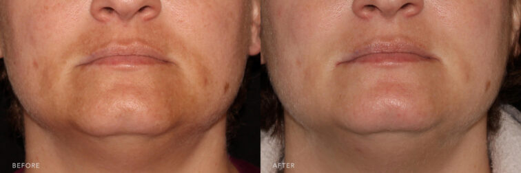 This are a photos of a woman's lower face before and after Micro-needing procedure. Before photo shows brown stains around her mouth while after photo shows brighter and cleansed skin around her mouth.| Albany, Latham, Saratoga NY, MedSpa