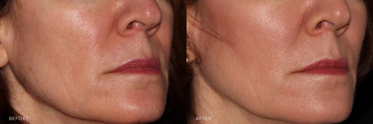 This is a side by side photo of a woman's face with a copper hair before and after Voluma procedure. Before photo shows redness on her cheeks and brown spot from her cheeks through her jowls while after photo shows evenly toned skin and highlighting her smooth and clearer skin.| Albany, Latham, Saratoga NY, MedSpa
