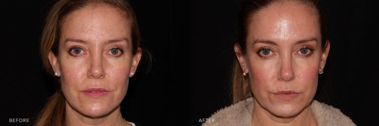 This is a photo of a woman's face before and after Voluma procedure. Before photo shows uneven shaped jowls and fleshy cheeks while after photo shows more tighter skin on her cheeks and evenly curved jawline that makes her look younger. | Albany, Latham, Saratoga NY, MedSpa
