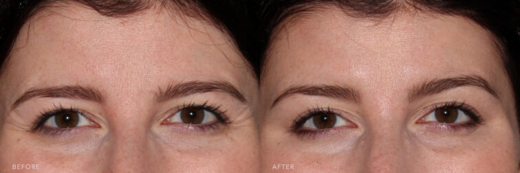 This is a photo of a woman's upper face with black hair before and after Botox procedure. Before photo shows vissible crows feet beside her eyes while after photo shows younger and vibrant look with no vissible marks of wrinkly skin around her eyes.| Albany, Latham, Saratoga NY, MedSpa