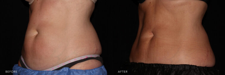 A side by side view photo of a woman's abdomen before and after Coolsculpting procudure. Before photo shows her bloated abdomen while her after photo shows more compressed and shapely abdomen.| Albany, Latham, Saratoga NY, MedSpa