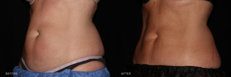 Real Results of Coolsculpting (Before/After Photos) - NOVA Plastic Surgery  and Dermatology