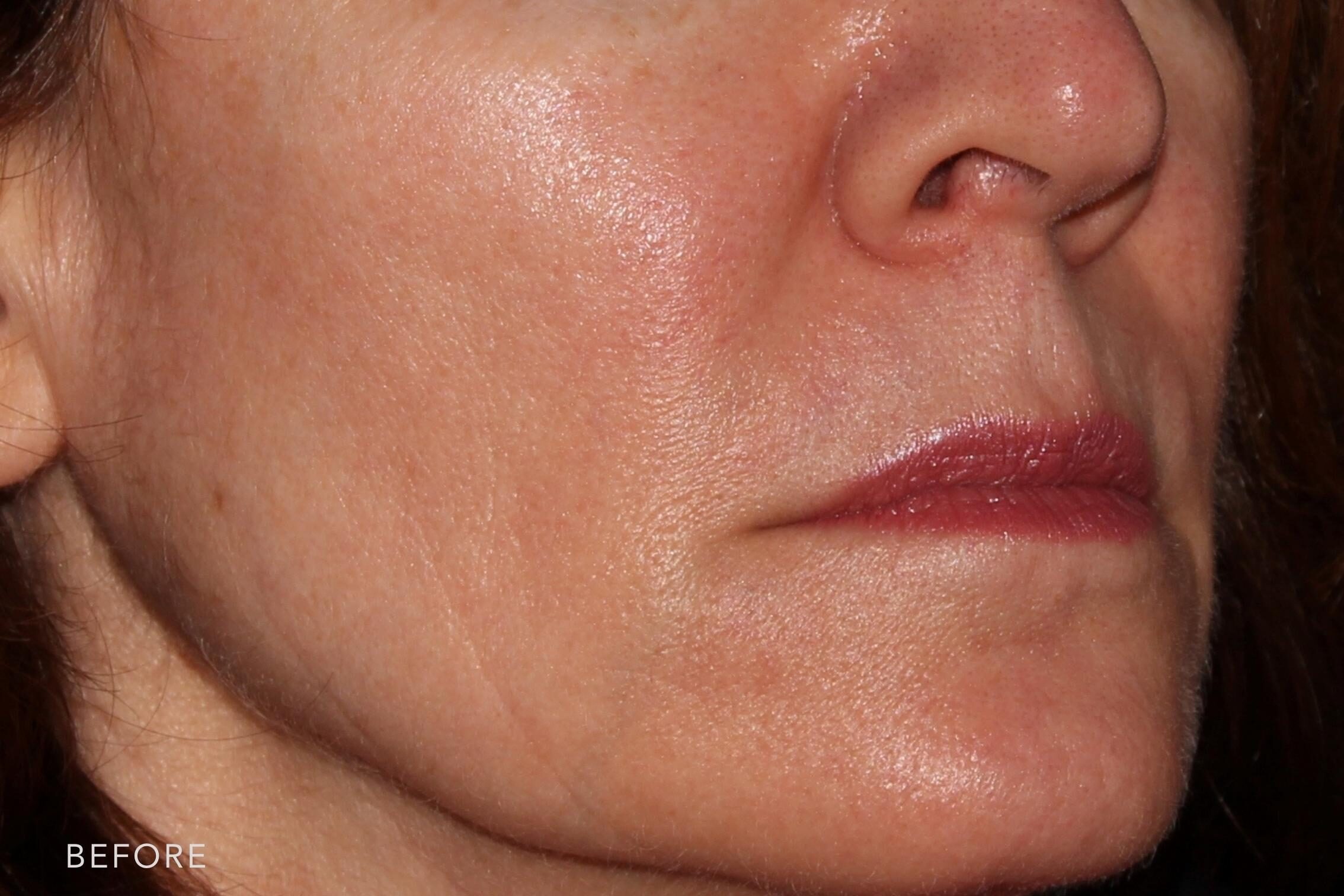 This is a side by side photo of a woman's face with a copper hair before and after Voluma procedure. Before photo shows redness on her cheeks and brown spot from her cheeks through her jowls while after photo shows evenly toned skin and highlighting her smooth and clearer skin.| Albany, Latham, Saratoga NY, MedSpa