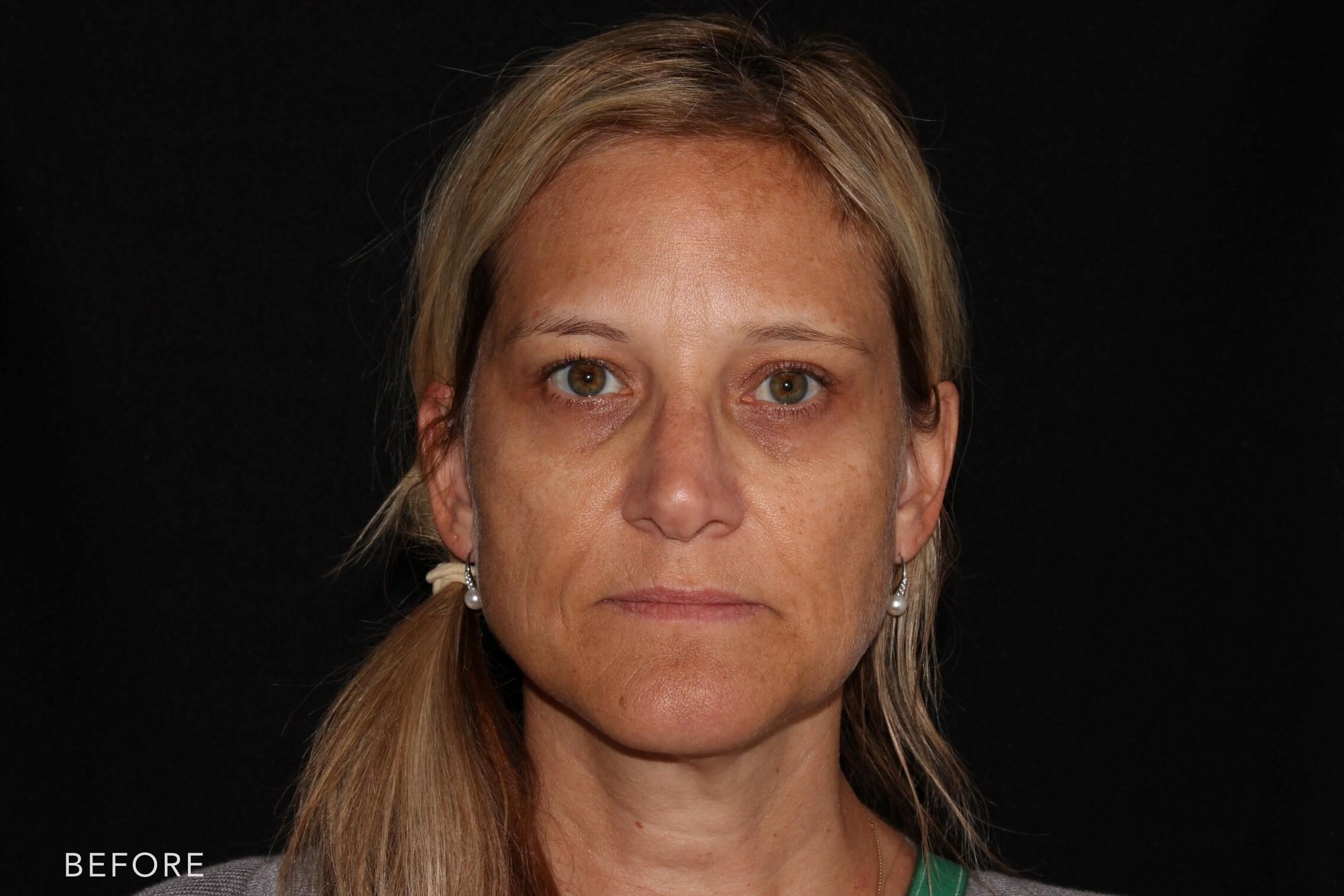 This is a blonde woman's photos before and after Botox and Dysport procedure. Before photo shows loose and wrinkled skin on her cheeks through her jowls with dark circles below her eyes while after photo shows more brighter and compact skin on her cheeks and evenly shaped jawline that makes her look younger.| Albany, Latham, Saratoga NY, MedSpa
