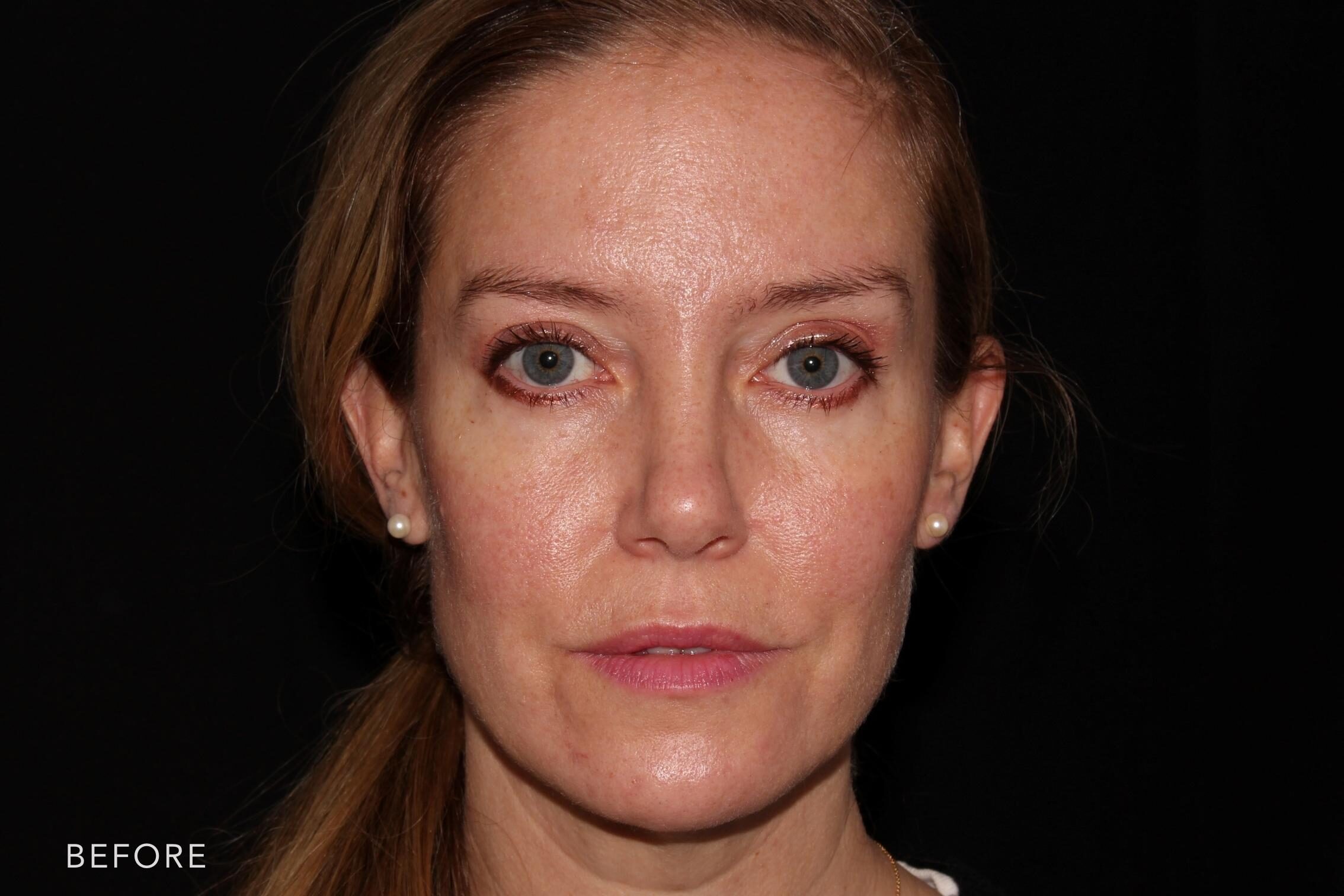This is a photo of a woman's face before and after Voluma procedure. Before photo shows uneven shaped jowls and fleshy cheeks while after photo shows more tighter skin on her cheeks and evenly curved jawline that makes her look younger. | Albany, Latham, Saratoga NY, MedSpa