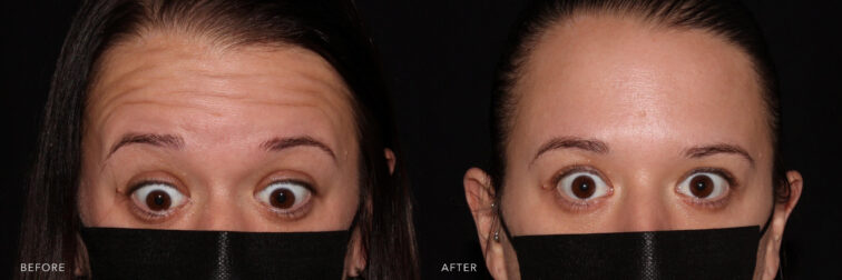 Side by side before and after of a woman's eyes and forehead up close before and after botox. Before she had wrinkles and afterwards her forehead is smooth.