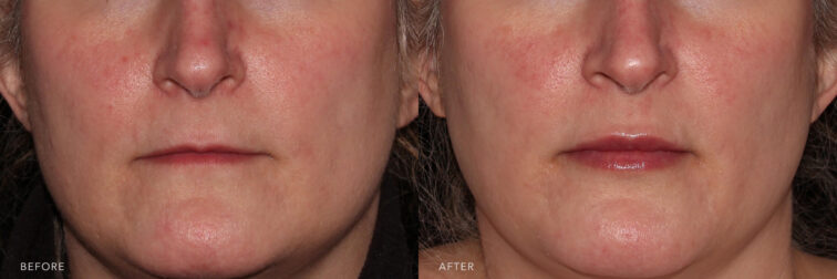 This is a side by side photo of a woman's lower face before and after Lip Filler procedure. Before photo shows her thinned lips and after photo shows more broader full lips. | Albany, Latham, Saratoga NY, MedSpa