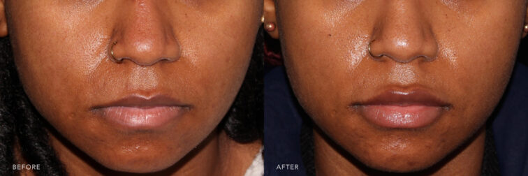 Side by side before and after of a Black young woman before and after lip filler. Before lip filler her top lip was smaller than the bottom and uneven. After filler her top lip is bigger and more in balance. | Albany, Latham, Saratoga NY, MedSpa