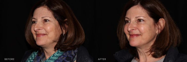 A side by side view of a woman's face with a copper colored hair before and after Botox procedure. Before photo shows her wrinkled lines around her eyes and frowned lines while after photo shows more youthful appearance with her smooth and more compressed skin.| Albany, Latham, Saratoga NY, MedSpa