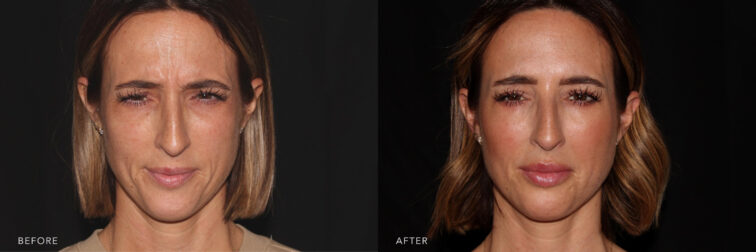 A photos of woman's face before and after Voluma, J Ultra and Dysport procedure. Before photo shows her furrowed look with her crinkled skin while after photos shows her youthful and calm look with her compressed skin on her face. | Albany, Latham, Saratoga NY, MedSpa”