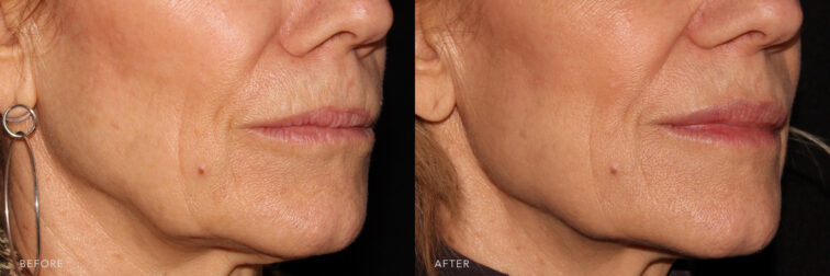 This is a side by side view photos of a woman's lower face before and after JawlineContour procedure. Before photo shows her jagged and unbalance jawline while after photo shows her evenly shaped and smooth jowls. | Albany, Latham, Saratoga NY, MedSpa