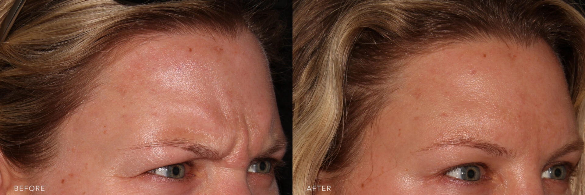 Close-up side-by-side comparison of a person's forehead showing improvement in skin texture and reduction in blemishes, marked "before" and "after.