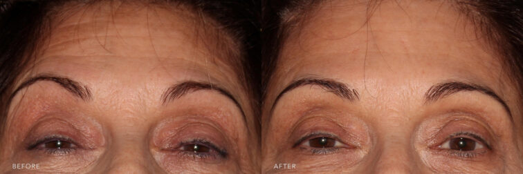 A photos of a woman's upper face before and after Forehead Botox procedure. Before photos shows her wrinkled lines on her forehead while after photos shows her smoother skin on her forehead with her younger look. | Albany, Latham, Saratoga NY, MedSpa