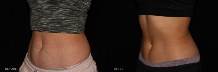 This is a side by side view photos of a woman's abdomen before and after CoolSculpting Abdomen procedure. Before photo shows a bloated and disfigured abdomen while after photo shows a shapely abdomen and well leveled body shape. | Albany, Latham, Saratoga NY, MedSpa