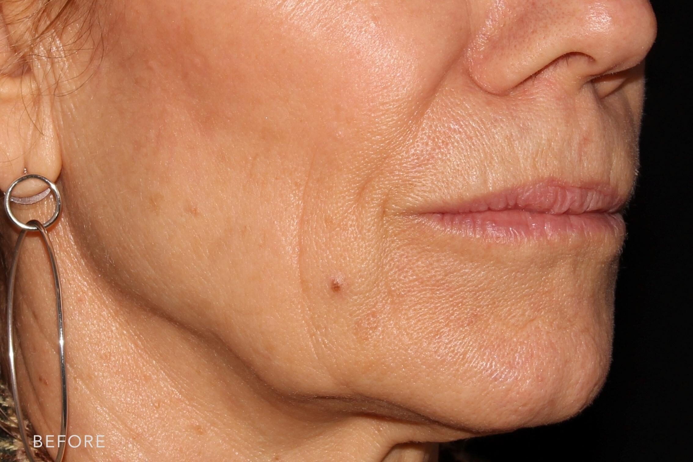 This is a side by side view photos of a woman's lower face before and after JawlineContour procedure. Before photo shows her jagged and unbalance jawline while after photo shows her evenly shaped and smooth jowls. | Albany, Latham, Saratoga NY, MedSpa