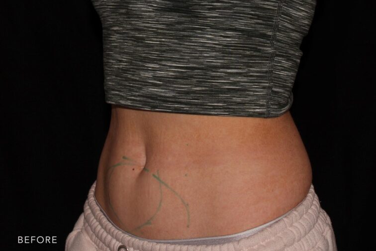 CoolSculpting Before & After Photo Gallery