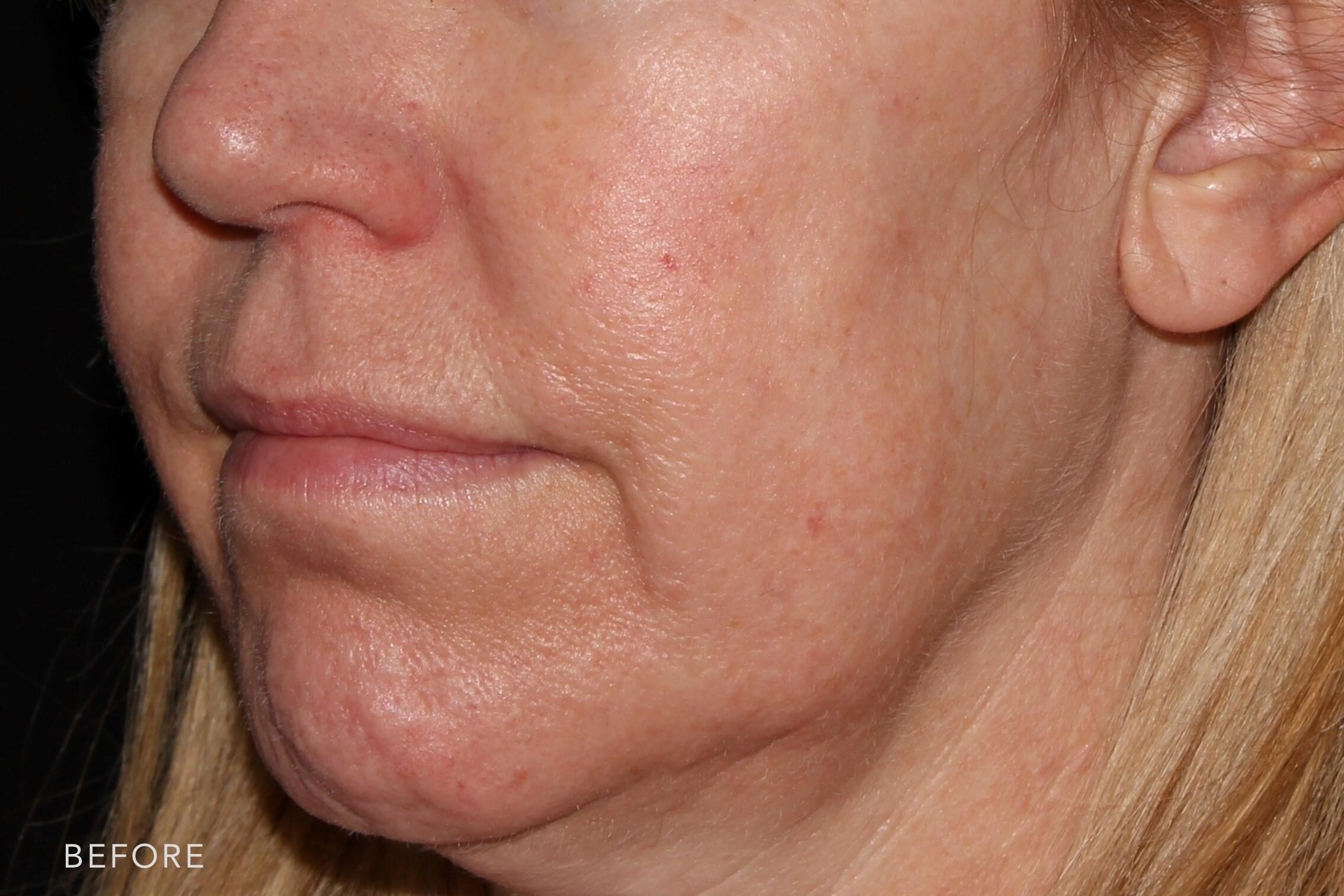 This is a side by side view photos of woman's lower face before and after Voluma procedure. Before photos shows her saggy jowls and uneven shape of her cheeks while after photos shows her compressed and tighter skin that makes her jawline more vissible. | Albany, Latham, Saratoga NY, MedSpa