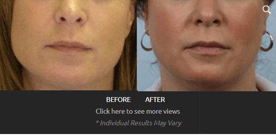 before and after image of women after getting botox for face symmetry