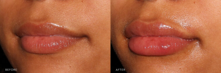 This is a side by side view photos of a woman's lower face before and after Lip Filler procedure. Before photo shows thin lips due to loss of collagen in her lips which reduced natural fullness and colour of her lips while after photo shows more volume to her lips that gave her a fuller and plumper lips. | Albany, Latham, Saratoga NY, MedSpa