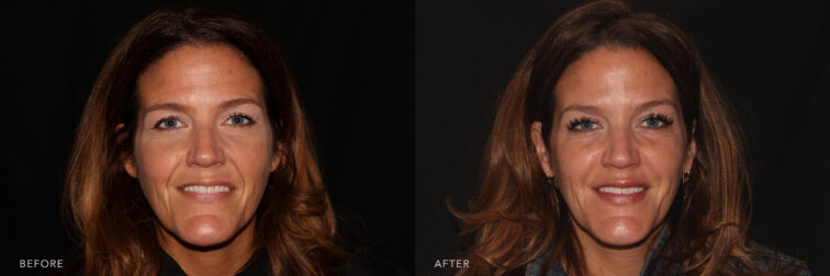 A photos of a woman's face before and after Botox and Dysport procedure. Before photo shows her saggy and baggy skin while after photos shows her tense and young looking face. | Albany, Latham, Saratoga NY, MedSpa