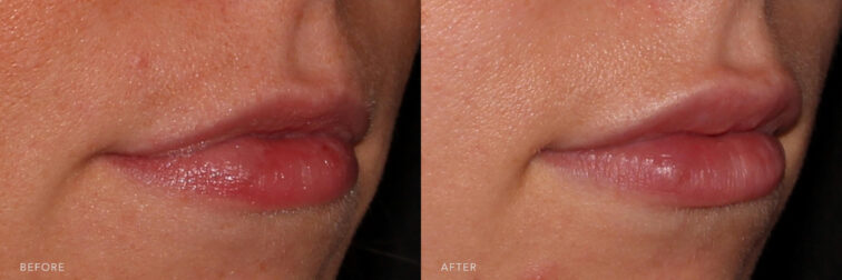 This is a photo of a woman's lips before and after Lip Filler Kysse procedure. Before photo shows her thin upper and lower lips while after photo shows a plump lips. | Albany, Latham, Saratoga NY, MedSpa