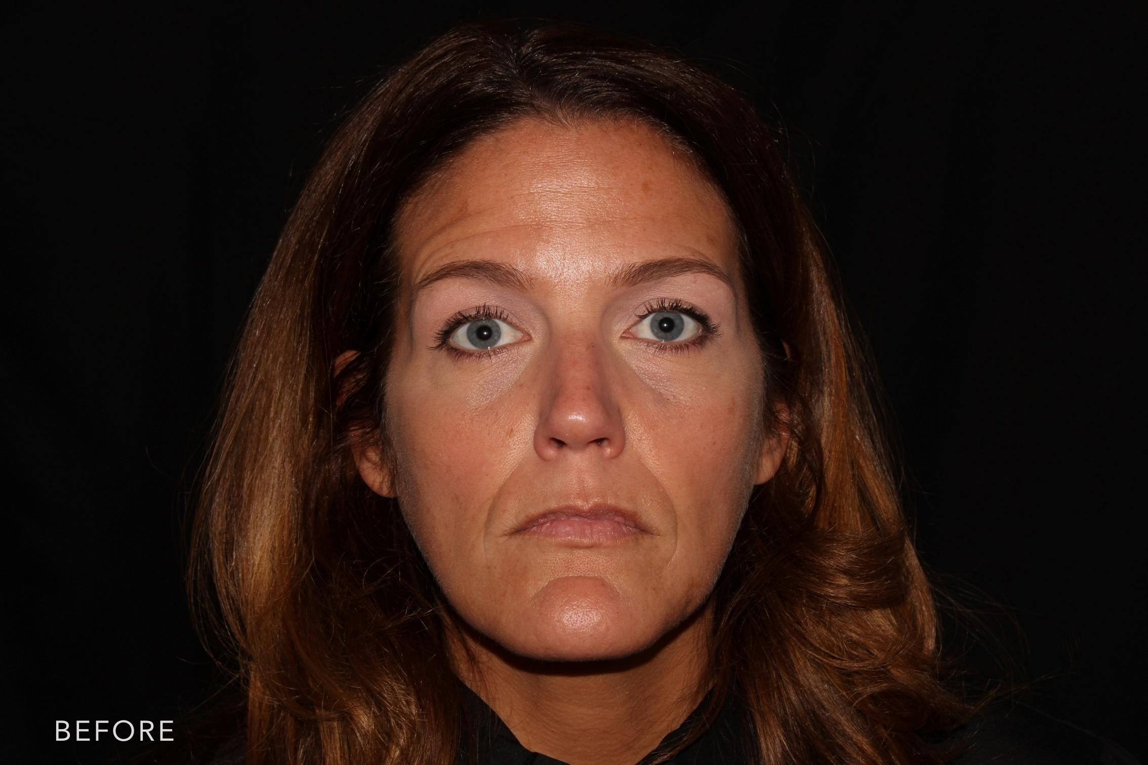 A photos of a woman's face before and after Botox and Dysport procedure. Before photo shows her saggy and baggy skin while after photos shows her tense and young looking face. | Albany, Latham, Saratoga NY, MedSpa