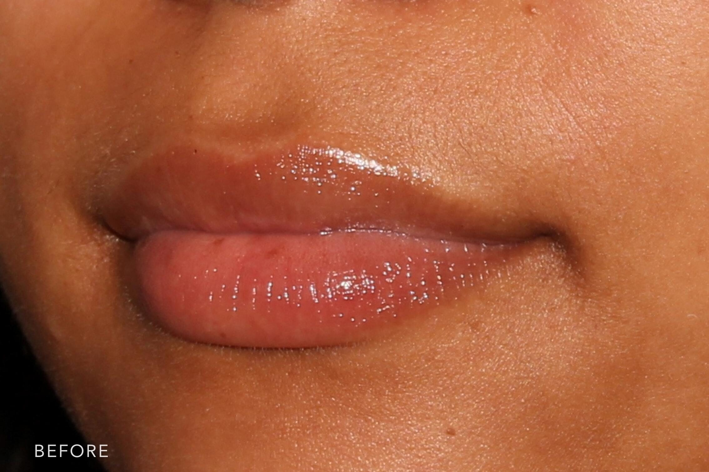 RC0036 Lip Filler Albany, Latham, Saratoga, NY The Rejuva at Williams