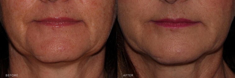 A photos of a woman's face before and after Botox and Filler procedure. Before photo shows a lost fat in her face that caused to have her skin to be wrinkly while after photo shows a restored and more youthful look with her smoothed out lines. | Albany, Latham, Saratoga NY, MedSpa