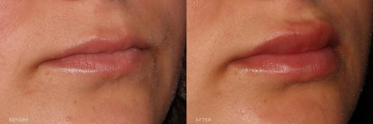 This is a side by side view photos of a woman's face before and after Kysse procedure. Before photo shows a lips that lost its volume and color while after photo shows more volume and smoother upper lip lines. | Albany, Latham, Saratoga NY, MedSpa