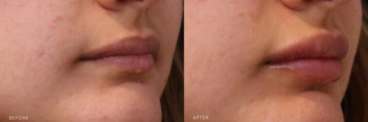 This is a side by side view photos of a woman's lower face before and after Lip Filler procedure. Before photo shows thin and increased vertical lines above her lips while after photo shows more restored lips size and more volume of her lips. | Albany, Latham, Saratoga NY, MedSpa