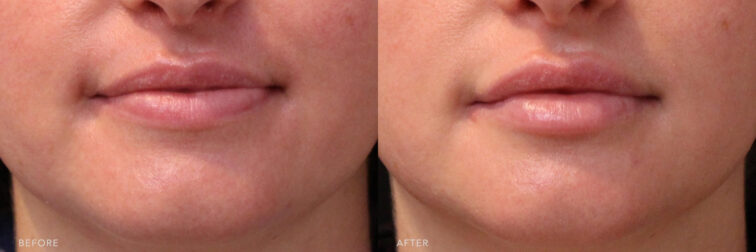 A photos of a woman's lower face before and after Lip Filler procedure. Before photo shows her slim lips that has less volume and a little elongated while after photo shows a restored and more volume to her lips. | Albany, Latham, Saratoga NY, MedSpa