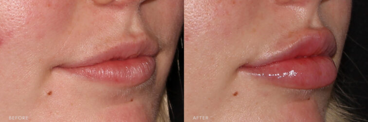 This is a side by side view photos of a woman's lower face before and after Lip Filler procedure. Before photo shows a lips that lost its volume making her lips to look thin or small while after photo shows her increased size and fullness of her lips. | Albany, Latham, Saratoga NY, MedSpa