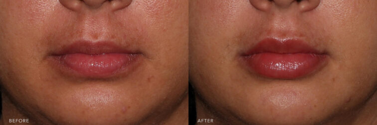 A photos of a woman's lower face before and after Lip Filler procedure. Before photo shows a long and flat lips with the increased distance between the corners of her mouth. | Albany, Latham, Saratoga NY, MedSpa