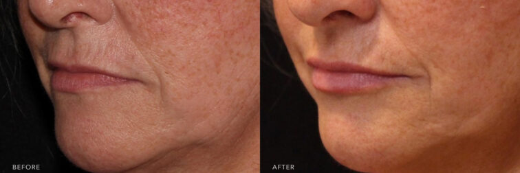 This is a side by side view photos of a woman's lower face before and after Lips Filler procedure. Before photo shows a long and elongated lips with wrinkles around her mouth while after photo shows a smoother lines and more volume to her lips. | Albany, Latham, Saratoga NY, MedSpa