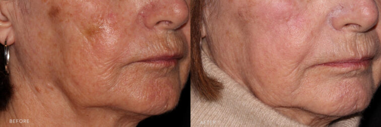 This is a side by side view photos of a woman's lower face before and after Sculptra procedure. Before photo shows a deep creases or folds to her mouth area while after photo shows her soft lines and more youthful skin to her mouth area. | Albany, Latham, Saratoga NY, MedSpa